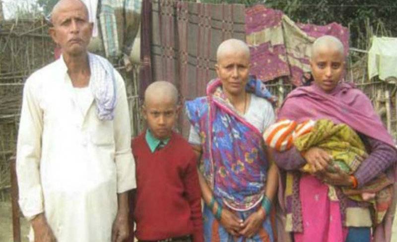 Family turns bald after taking bath in India