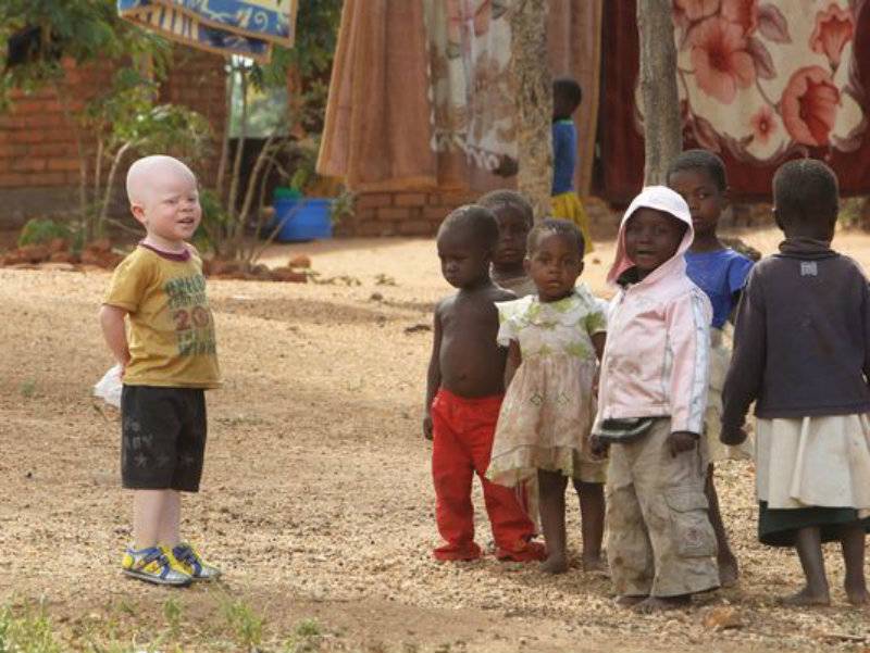 Cannibalism or spirituality? Albino children being killed in Malawi for use in ceremonies