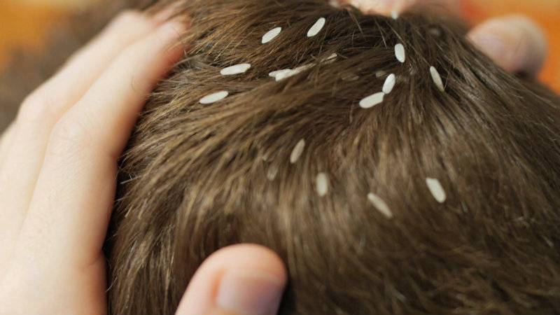 Head lice being sold in Dubai for a weird reason you have never heard of,  people