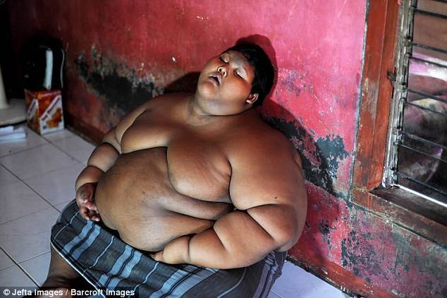 'World's fattest kid' saved by emergency surgery