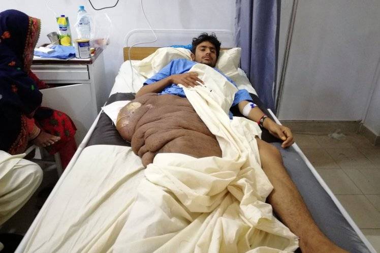 Pakistani teen with 44lb tumour awaits surgery in Karachi (VIDEO)