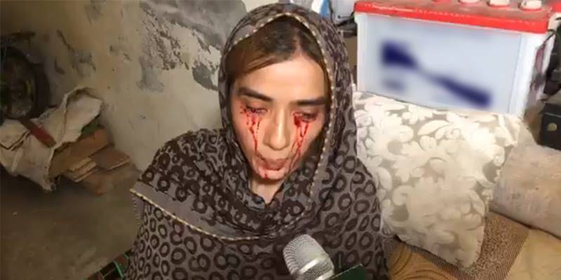 Lahore-based girl who sheds 'blood tears' seeks help for treatment