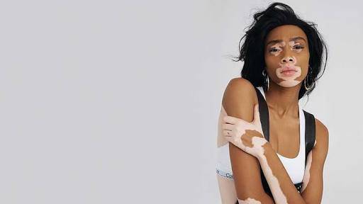 Winnie Harlow is defying the modeling norms with grace