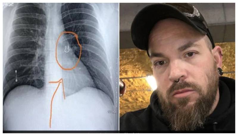 Missing nose piercing found in man's lungs after five years