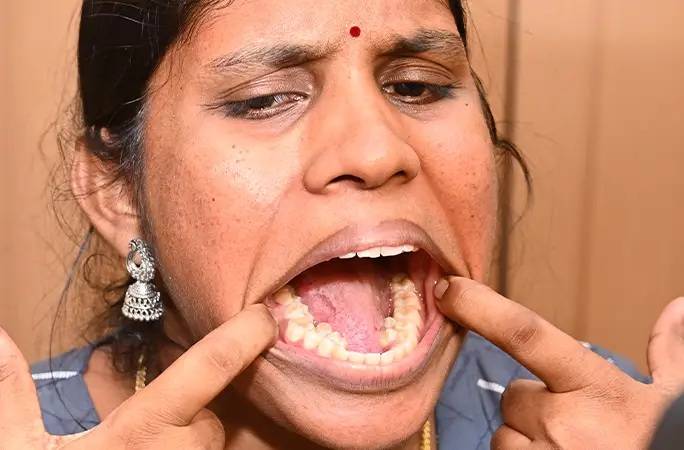Indian woman sets world record with most teeth