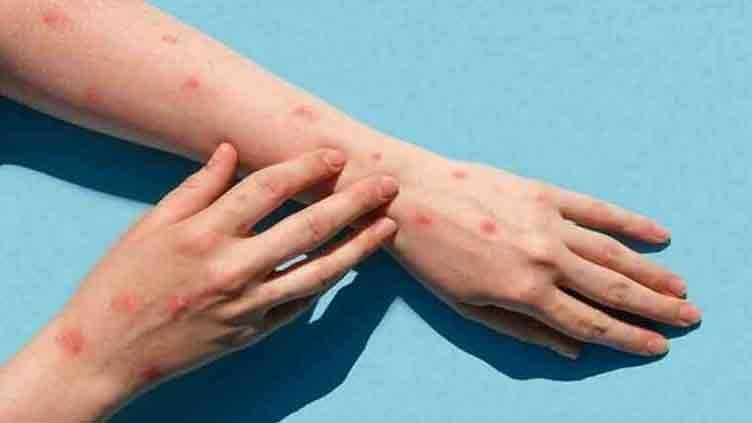 Pakistan Reports Seventh Case Of Monkeypox