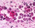 First Naegleria Death Reported In Karachi This Year