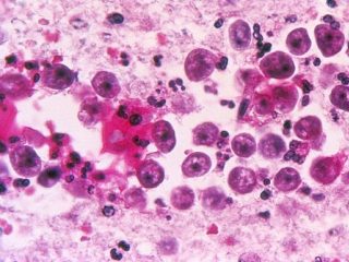 First Naegleria Death Reported In Karachi This Year