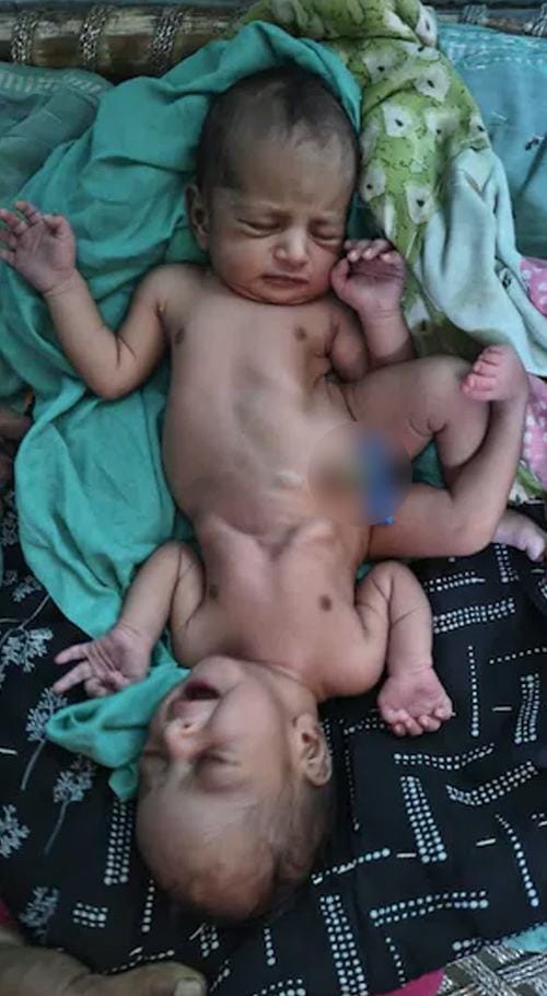 Baby Born With Two Heads Four Arms Shocks World In Rare Birth 