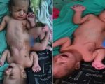 Baby Born With Two Heads Four Arms Shocks World In Rare Birth