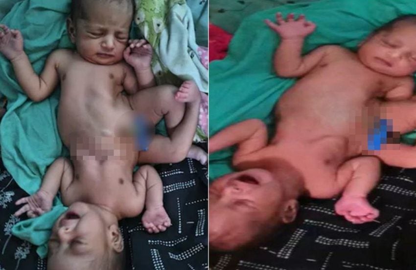 Baby Born With Two Heads Four Arms Shocks World In Rare Birth