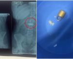 Karachi Doctors Remove Metal Lock From Womans Stomach Without Surgery