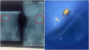 Karachi Doctors Remove Metal Lock From Womans Stomach Without Surgery
