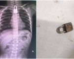 Lock Successfully Removed From Throat Of 3 Year Old Child In Faisalabad