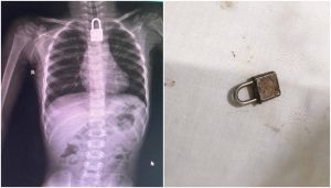 Lock Successfully Removed From Throat Of 3 Year Old Child In Faisalabad
