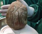 1 3kg Bladder Stone Removed From Man After Years Of Silent Suffering
